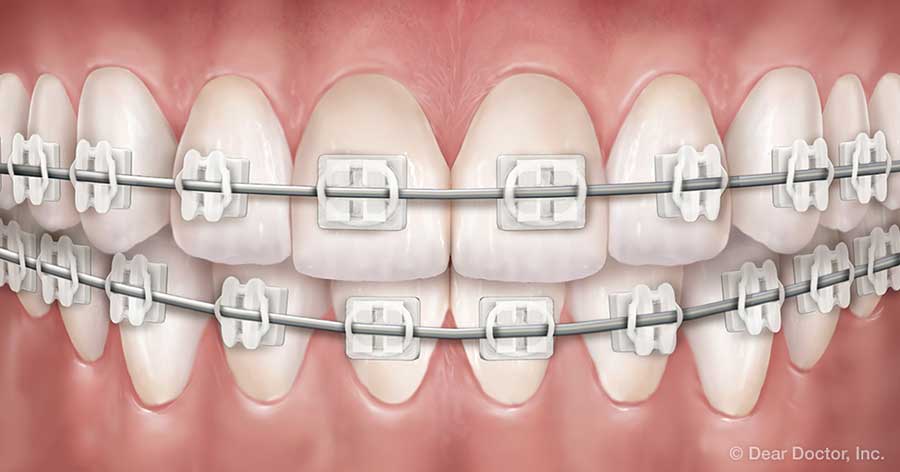 Cuidado de Ortodoncia en Adolescentes - General and Cosmetic Dentist