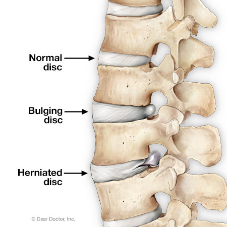 Bulging and herniated disc.