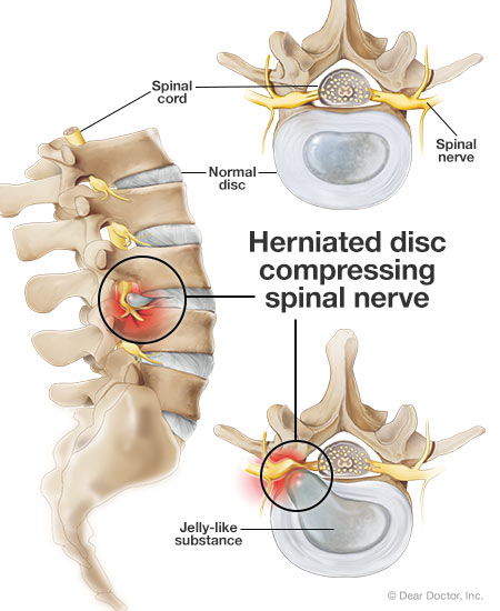 Herniated disc.