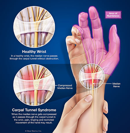 Carpal Tunnel Syndrome