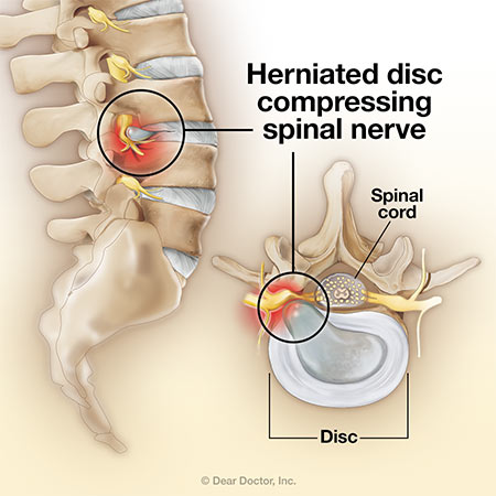 Herniated Disc.