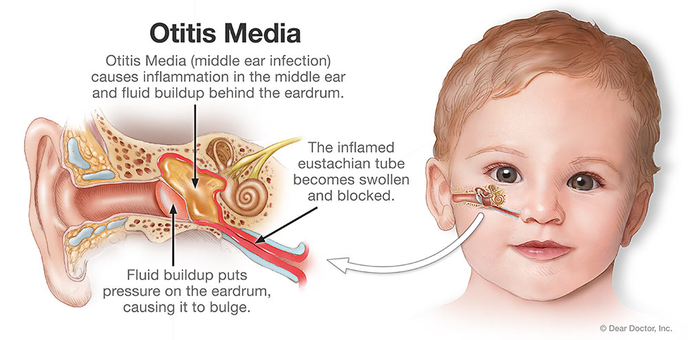 Otitis Media.