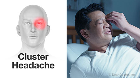 Cluster headache.