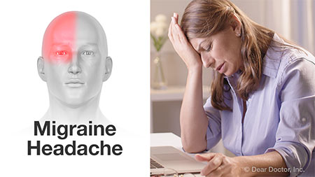 Migraine headache.