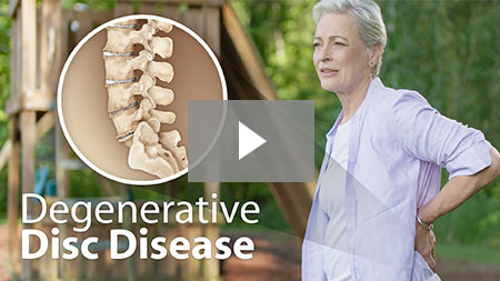 Degenerative disc disease.