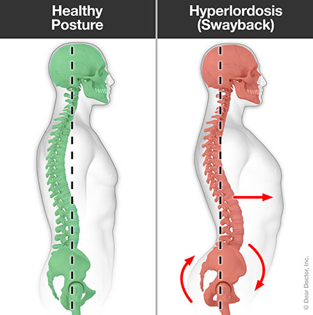 Hyperlordosis (swayback).