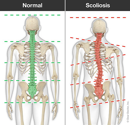 Scoliosis.