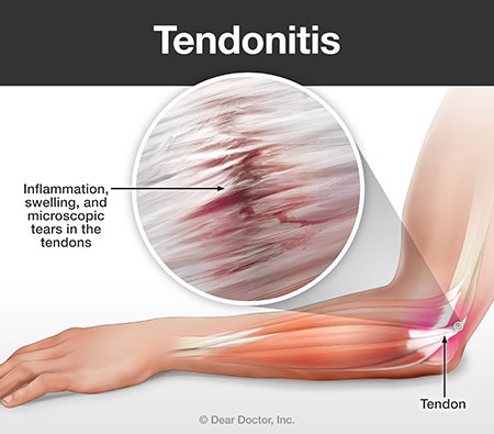 Tendonitis.