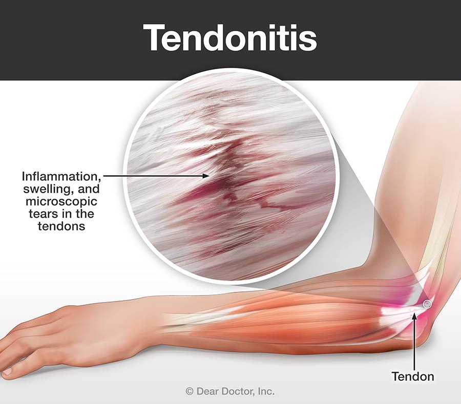 Tendonitis Tendinitis