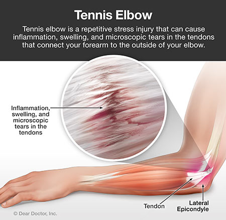 Tennis Elbow and How We Treat It